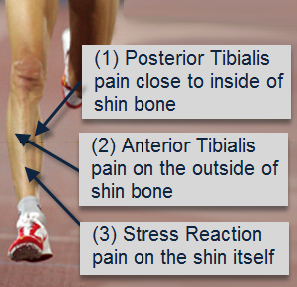 Shin Splint Treatment: How Improving Calf Strength Can Fix Your