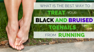 Black toenails from running are not only painful, but can end up infected or falling off. If your toenail hurts, this article will explain how common black toenails are for runners, what causes them so you can avoid black toenails in the future, and how to treat your bruised toenail correctly, so they can heal in less time.