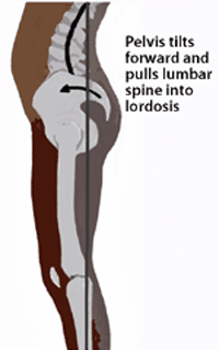 Image result for lower back pain due to lordosis