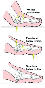 Why Your Big Toe Might be the Cause of Your Running Injuries (And How ...