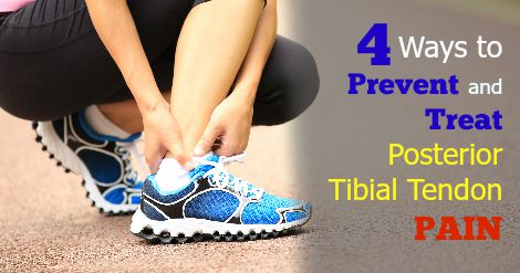 4 Ways to Prevent and Treat Posterior Tibial Tendonitis