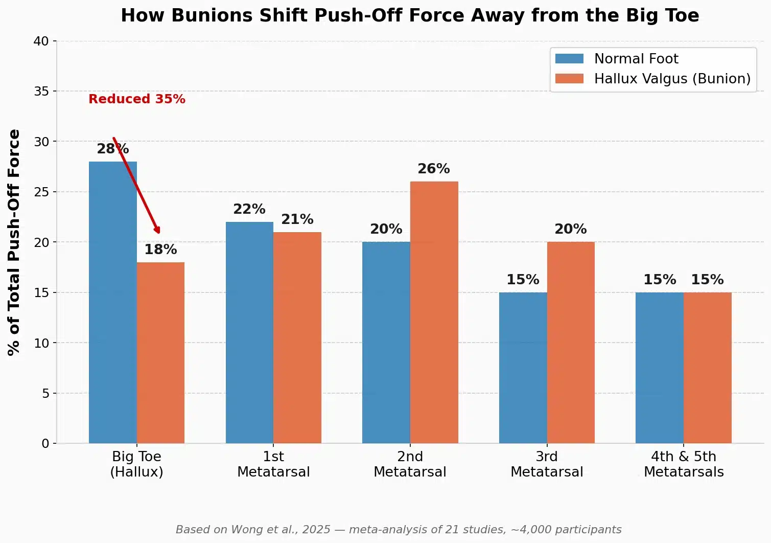 Bar chart comparing push-off force distribution between normal feet and hallux valgus across five foot regions, showing 35% reduction in big toe loading force