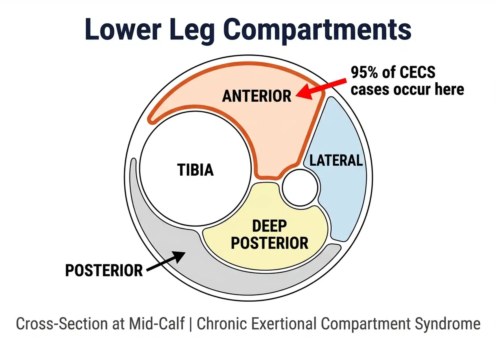 Diagram of the four lower leg compartments showing where chronic exertional compartment syndrome occurs in runners